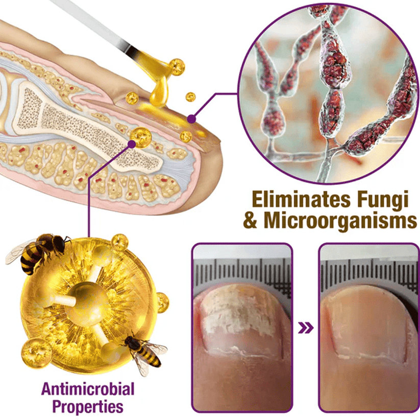 Flysmus - Suero para tratamiento de uñas con veneno de abeja